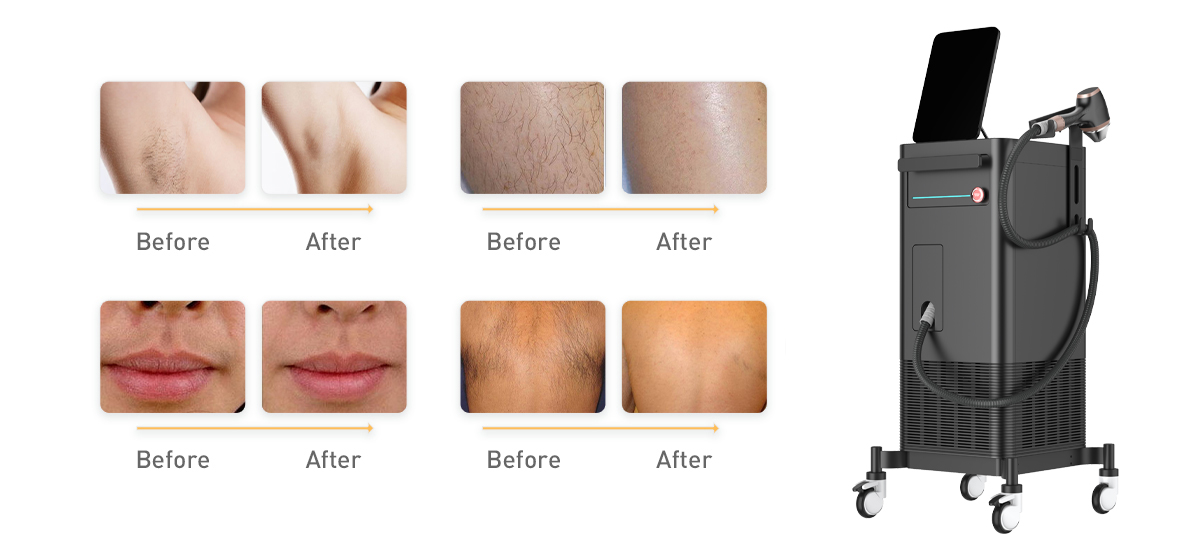 ¿Qué Método de depilación láser es mejor?